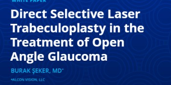Direct Selective Laser Trabeculoplasty in the Treatment of Open Angle Glaucoma